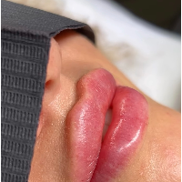fillers