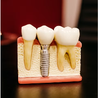 Implantat