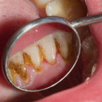 Förebyggande tandvård