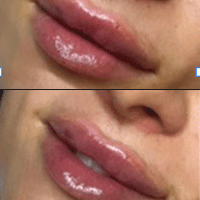 BOTOX