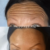 FILLERS