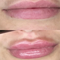 Botox